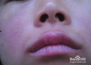 嘴周围过敏图片,嘴周过敏症状图解与应对策略